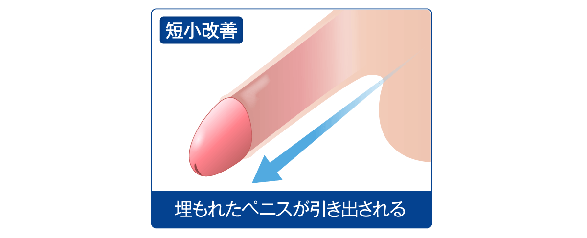短小ペニスの改善にも効果的