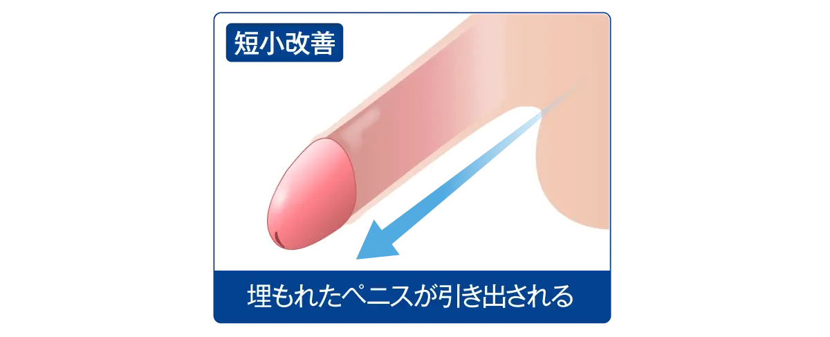 短小ペニスの改善にも効果的