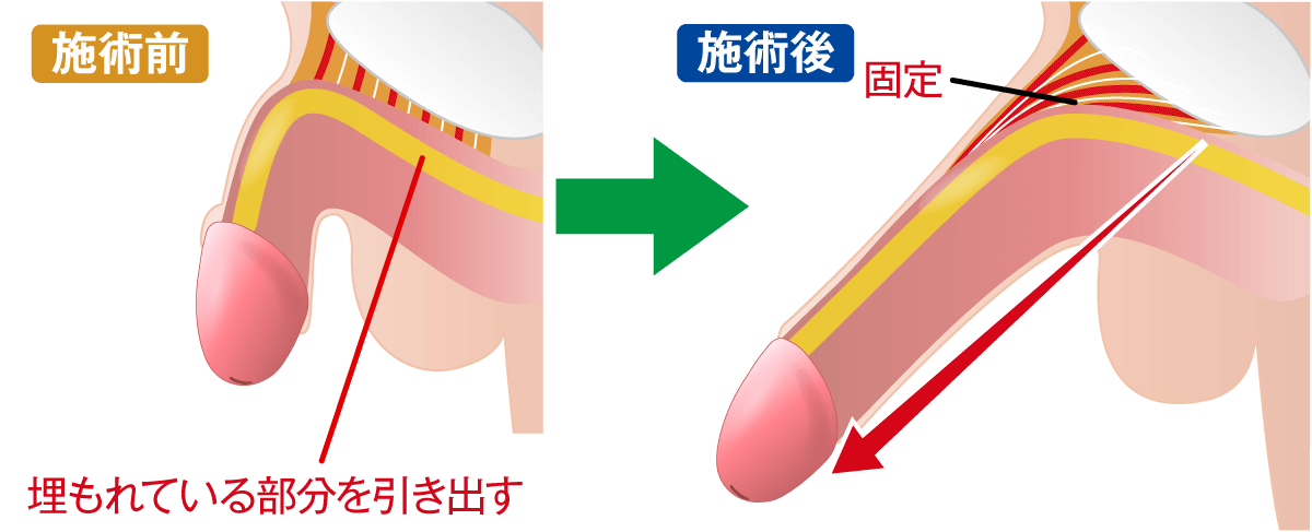 切らない長茎術 埋没陰茎牽引固定法