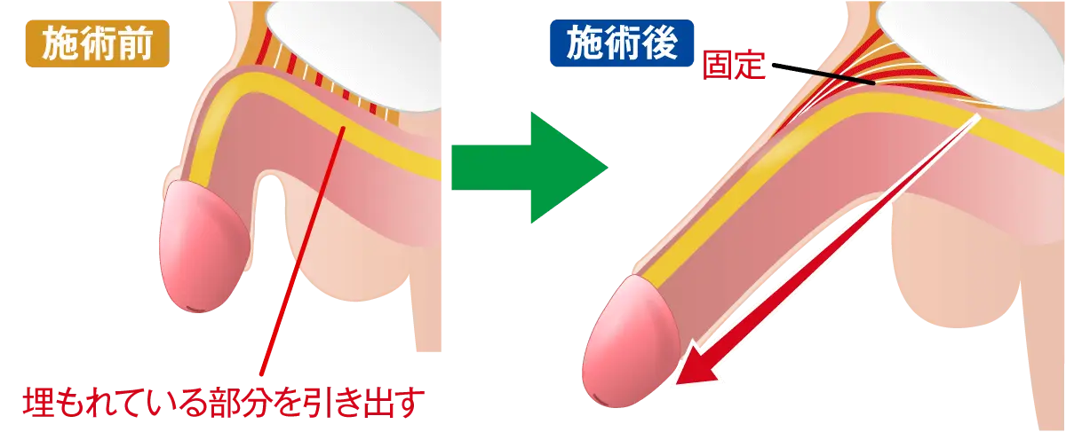 切らない長茎術 埋没陰茎牽引固定法