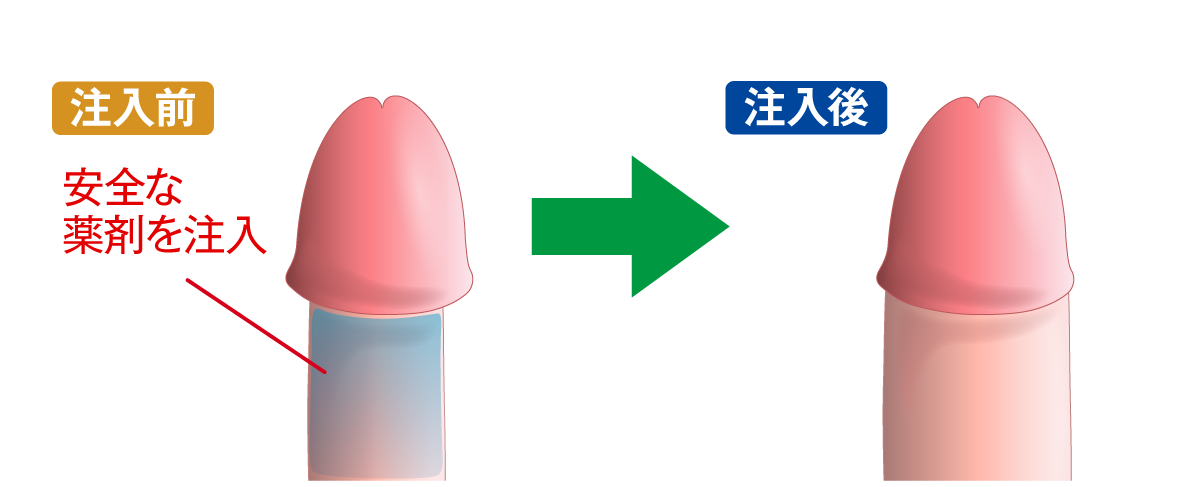 陰茎増大術とは
