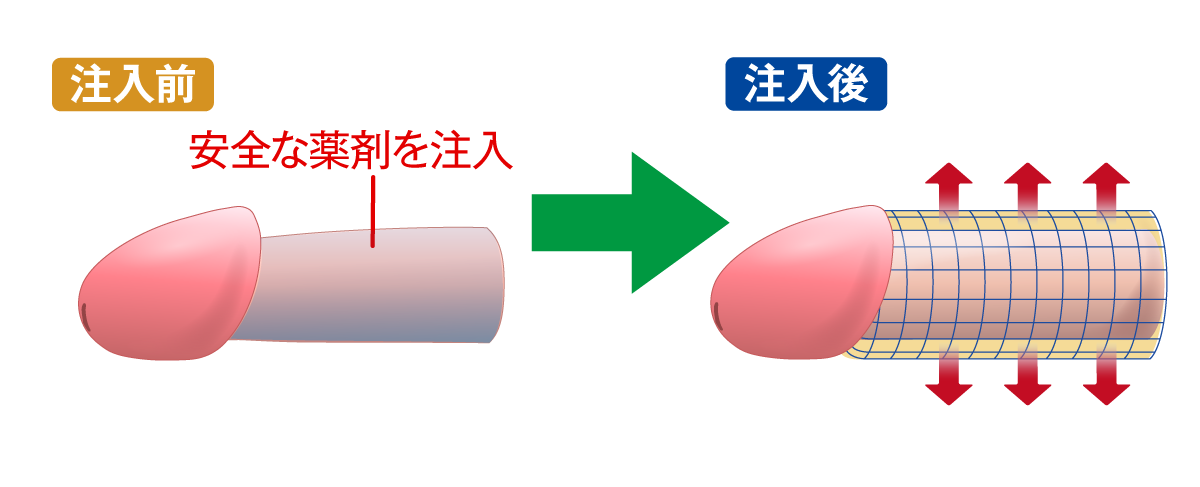 陰茎部薬剤注入法