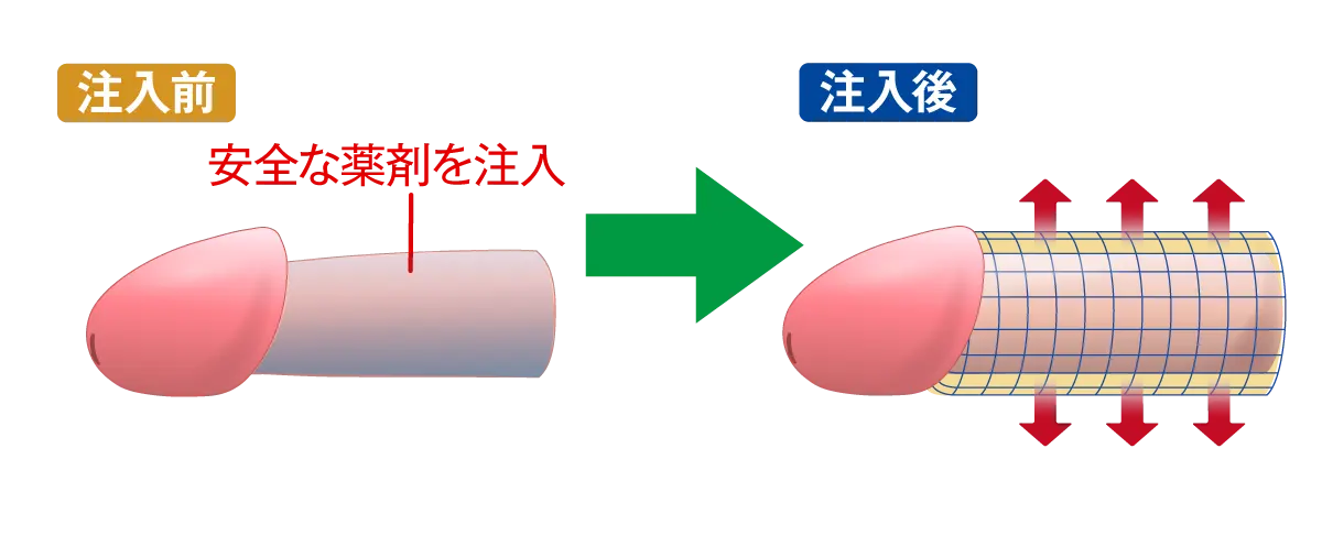 陰茎部薬剤注入法