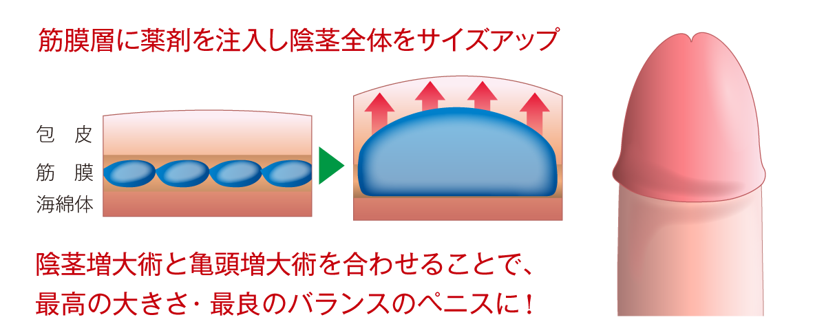全体注入法
