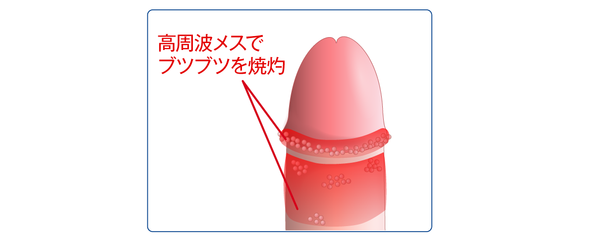 痛みのない20分の焼灼治療