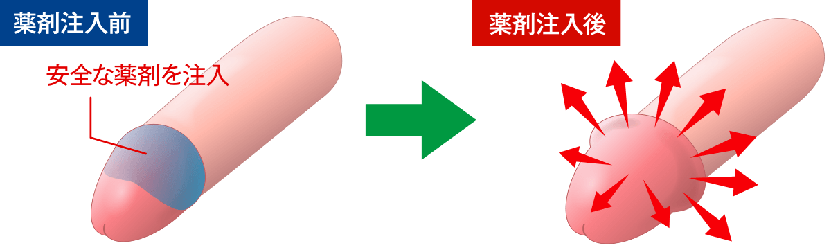 亀頭増大術とは