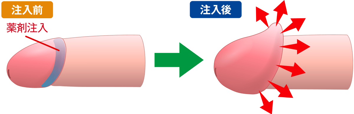 カリ高注入法