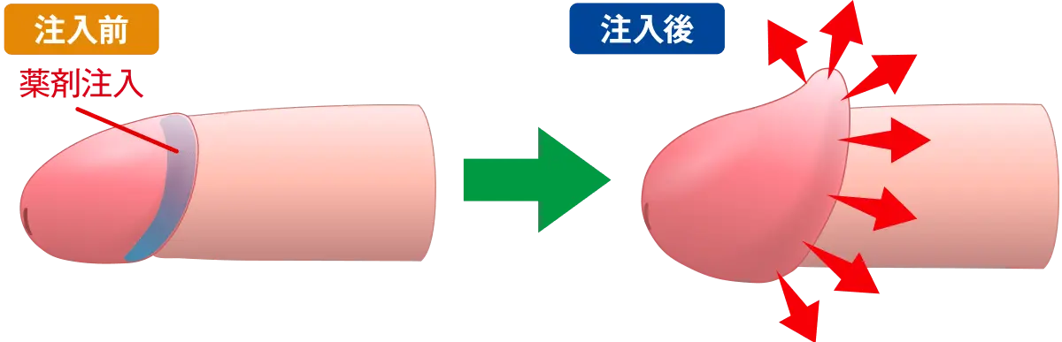 カリ高注入法