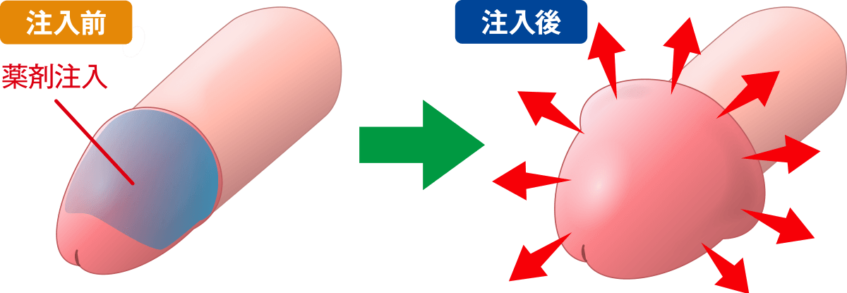 全体注入法