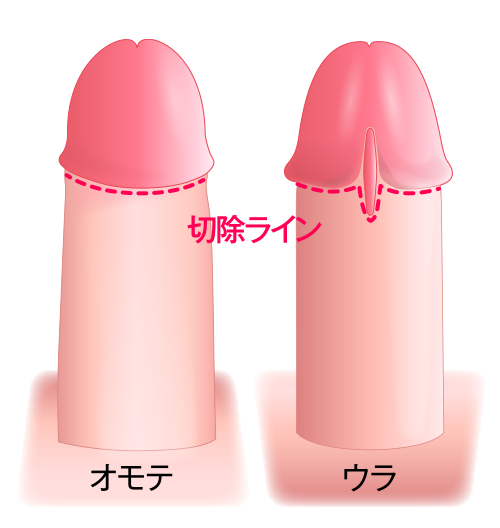 精密縫合