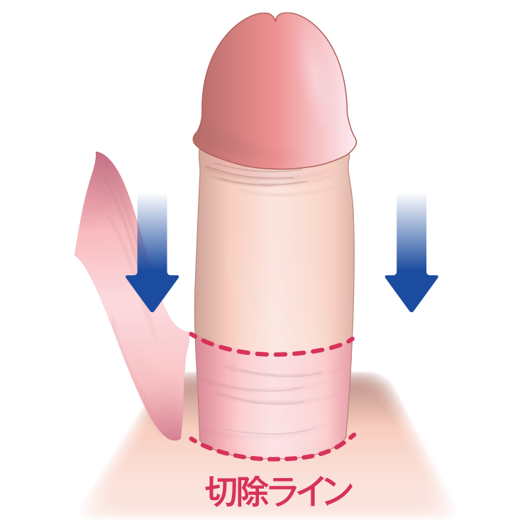 精密切除
