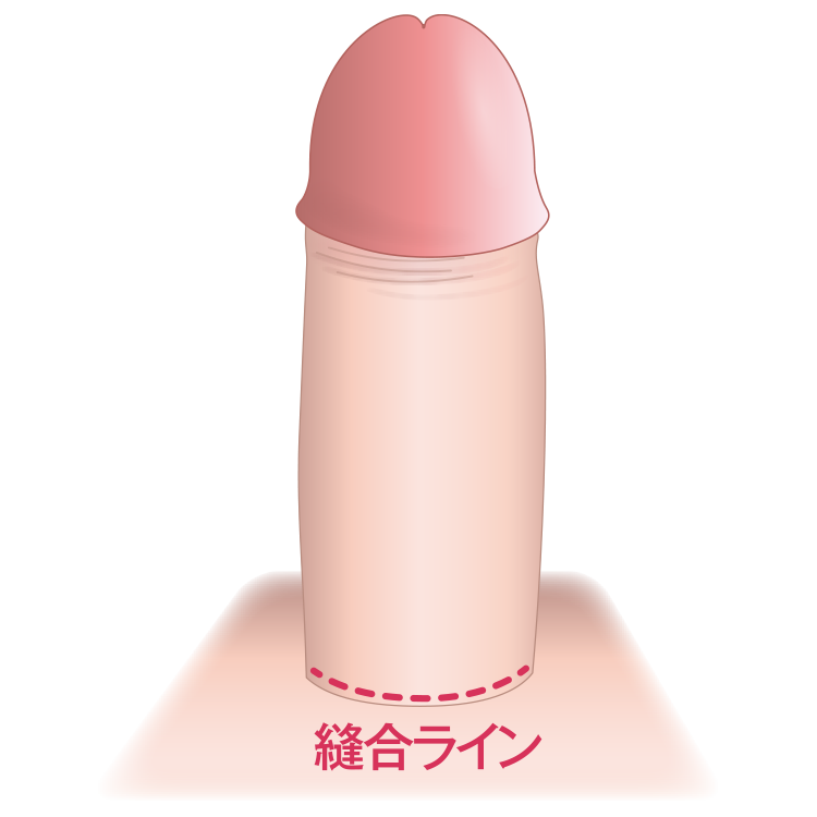 精密縫合