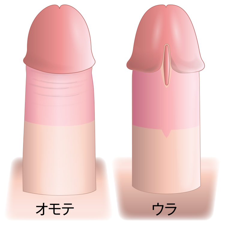 精密切除