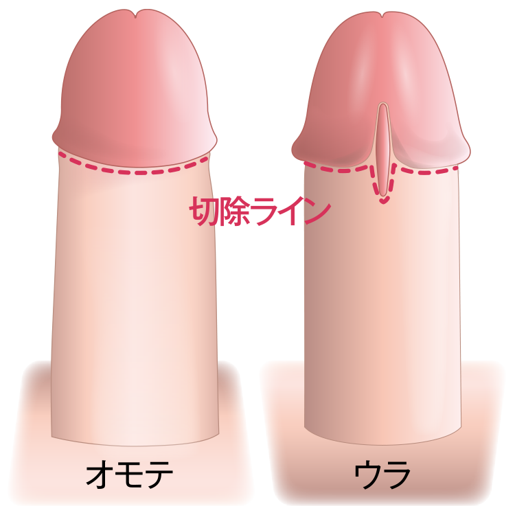 精密縫合