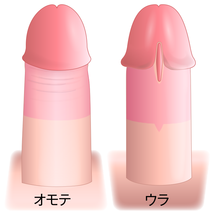 精密切除