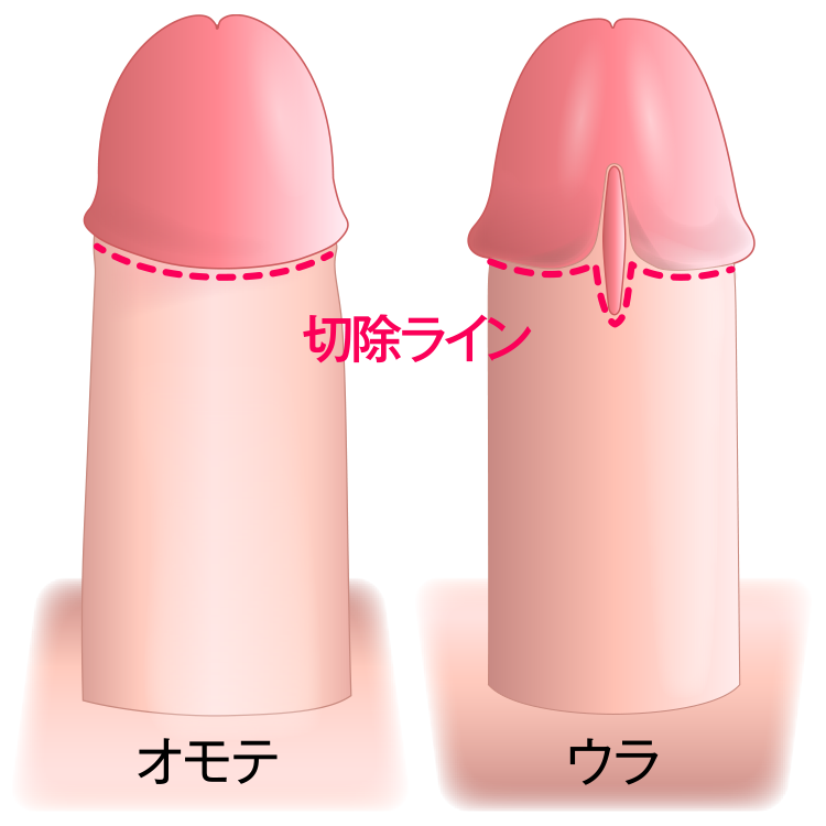 精密縫合